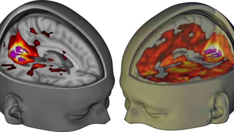 Έτσι επιδρά το LSD στον εγκέφαλο