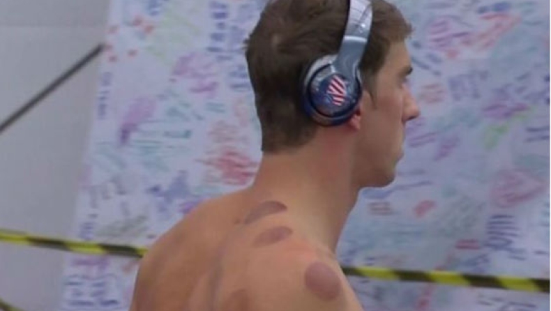 Γιατί Φελπς και άλλοι Αμερικανοί κολυμβητές έχουν μελανιές στο σώμα τους (pic)