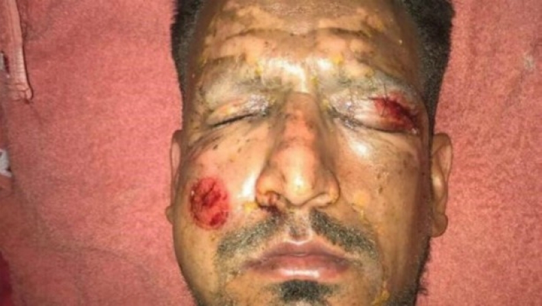 Σοκαριστικός τραυματισμός στο πρόσωπο από πυροτεχνήματα για τον Βιάτρι (pics)