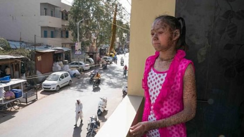 Σπάνια πάθηση μετέτρεψε την επιδερμίδα έφηβης Ινδής σε δέρμα φιδιού (pics & vid)