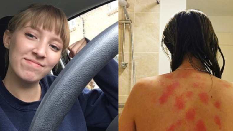 Η 19χρονη Βρετανίδα που έχει αλλεργία στο νερό, τα δάκρυα και τον ιδρώτα της (pics)