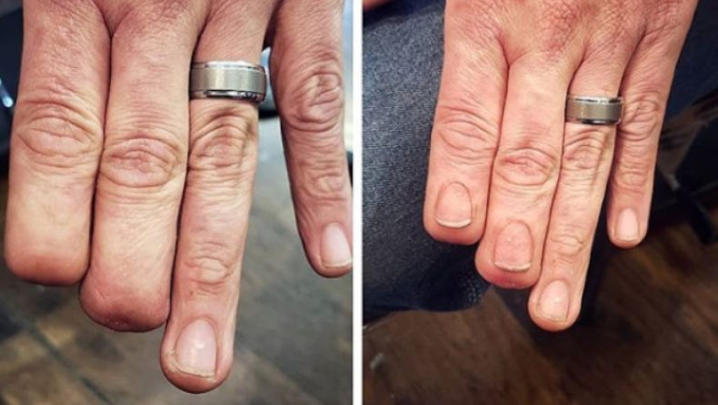 Πώς με τη δύναμη του τατουάζ ένας άνθρωπος απέκτησε και πάλι τα δάχτυλά του (pics)