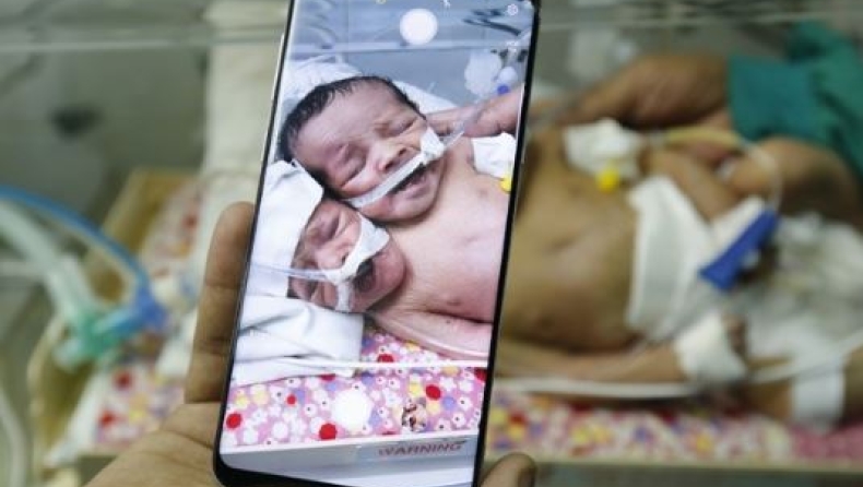 Πέθαναν τα σιαμαία βρέφη που νοσηλεύονταν σε νοσοκομείο της Υεμένης