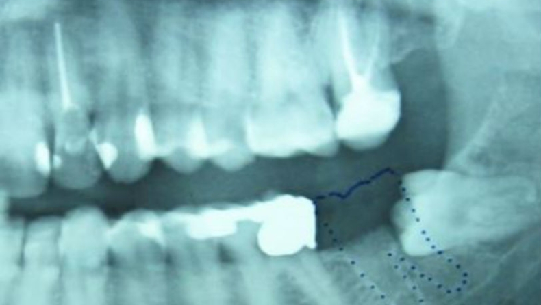 Απίστευτο: Ένα δόντι μεγάλωνε στα γεννητικά όργανα 13χρονου (pics)