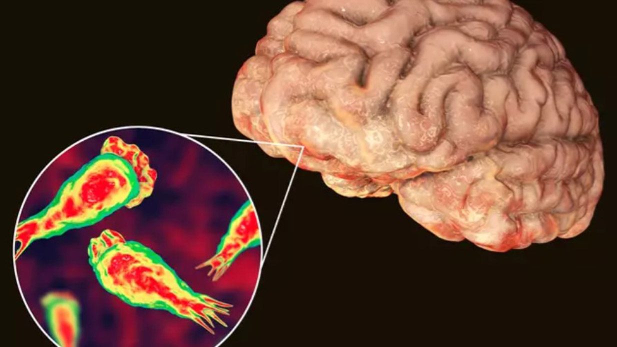 Αμοιβάδα - Εγκέφαλος