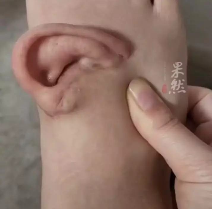 «Φόρεσε» το αυτί στο πόδι της για 5 μήνες