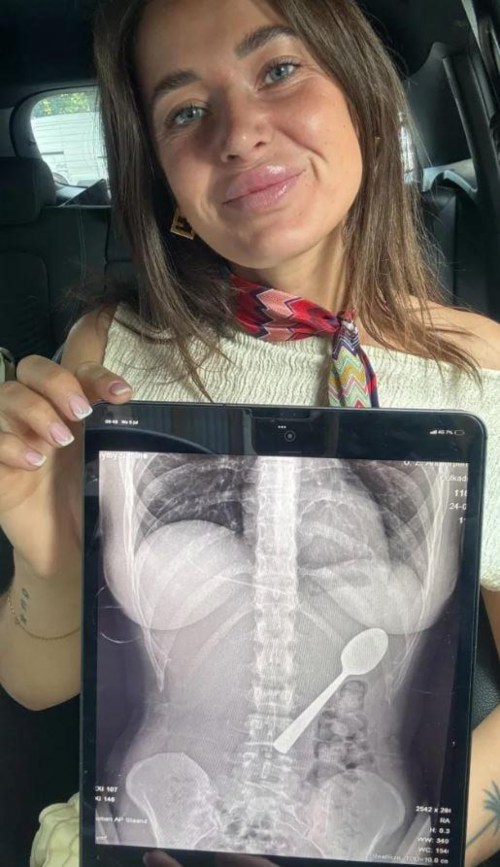 Η ακτινογραφία με το κουτάλι