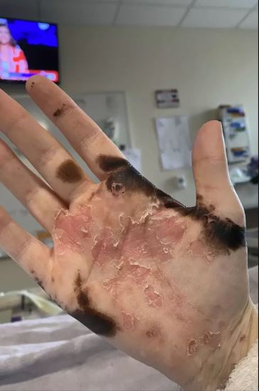 Τα χέρια της Ρότζερς μετά την κατανάλωση της ιβουπροφαίνης