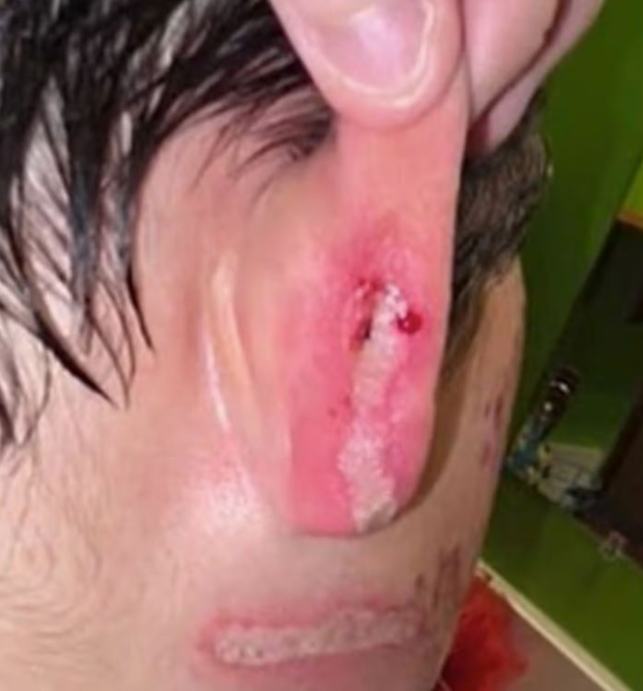 Τα εγκαύματα του 9χρονου