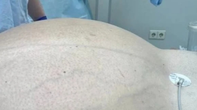 «Δεν με εμπόδιζε»: Αφαίρεση γιγάντιου όγκου 60 κιλών από 50χρονο