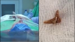 Γυναίκα στα Χανιά ζούσε για μήνες με ένα κόκαλο από κουνέλι στον πνεύμονά της (vid)