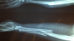 H περίεργη θεωρία για ανθρώπους που «δεν έχουν σπάσει ποτέ κόκαλο»