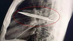 Τανζανία: Έβγαζε πύον από τις θηλές του και οι γιατροί ανακάλυψαν μαχαίρι στο στήθος του επί 8 χρόνια (vid)