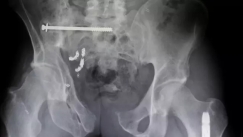 Η κυβέρνηση των ΗΠΑ αποκάλυψε τα 25 χειρότερα πράγματα που κόλλησαν σε οπίσθια ανθρώπων το 2025