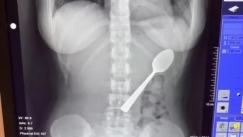 Βέλγιο: 28χρονη κατάπιε κουτάλι 17 εκατοστών όταν πήδηξε πάνω της ο σκύλος της