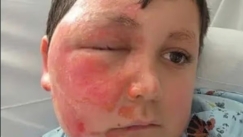 Έβαλε σε φούρνο μικροκυμάτων παιχνίδι και κατέληξε με εγκαύματα β' βαθμού σε πρόσωπο και χέρια (vid)