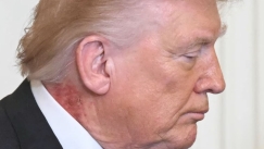 Η εξήγηση για το περίεργο εξάνθημα του Τραμπ στον λαιμό του