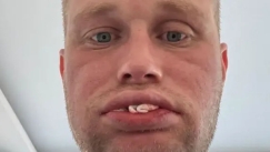 Εφιάλτης για Βρετανό: Πλήρωσε 3.500 λίρες για «νέα δόντια» στην Τουρκία και τα έχασε όλα