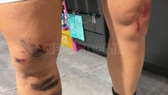 Κρυονέρι: Άγρια επίθεση λύκου σε κάτοικο - «Πάλευα για τη ζωή μου 8 λεπτά»