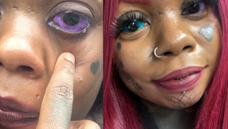 Γυναίκα τυφλώθηκε αφού ήθελε να μοιάζει με το «dragon girl» και έκανε τατουάζ στα μάτια της (vid)