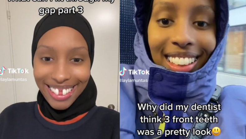 «Κομπογιαννίτης» οδοντίατρος έγινε viral αφού εμφύτεψε λάθος δόντι σε ασθενή (vid) 