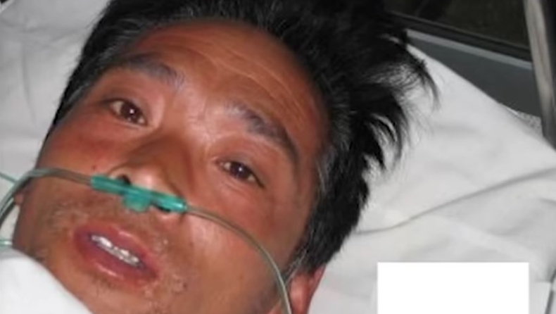Ο πιο ραδιενεργός άνθρωπος κατάφερε να μείνει στη ζωή για 83 μέρες: Έκλαιγε αίμα και έλιωνε το δέρμα του