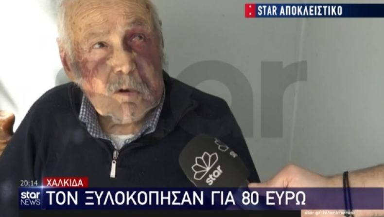  90χρονος στην Χαλκίδα ξυλοκοπήθηκε βάναυσα για για 80 ευρώ: «Με έπιασε από το λαιμό να με πνίξει» (vid)
