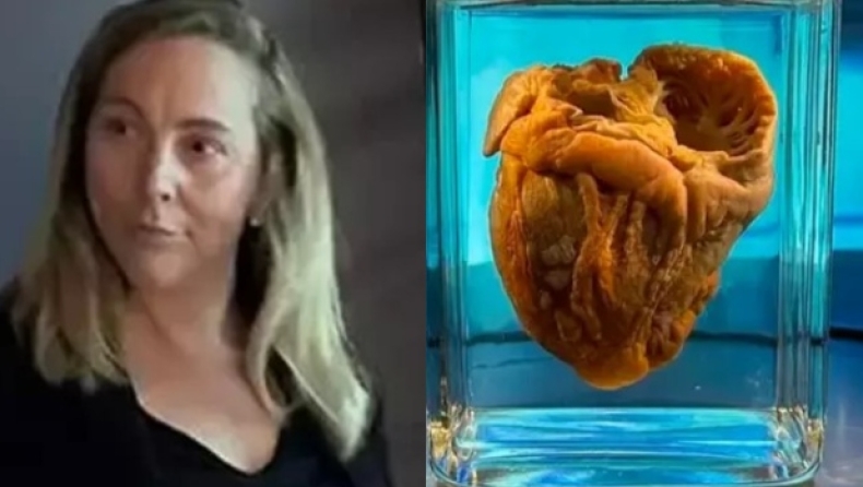 Γυναίκα είδε την καρδιά της σε μουσείο μετά από 16 χρόνια αφότου την αφαίρεσε 