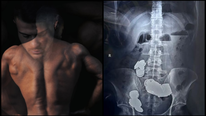 «Σφίχτης» κατανάλωσε 39 νομίσματα και 37 μαγνητάκια: «Ο ψευδάργυρος βοηθά στο bodybuilding» (vid)