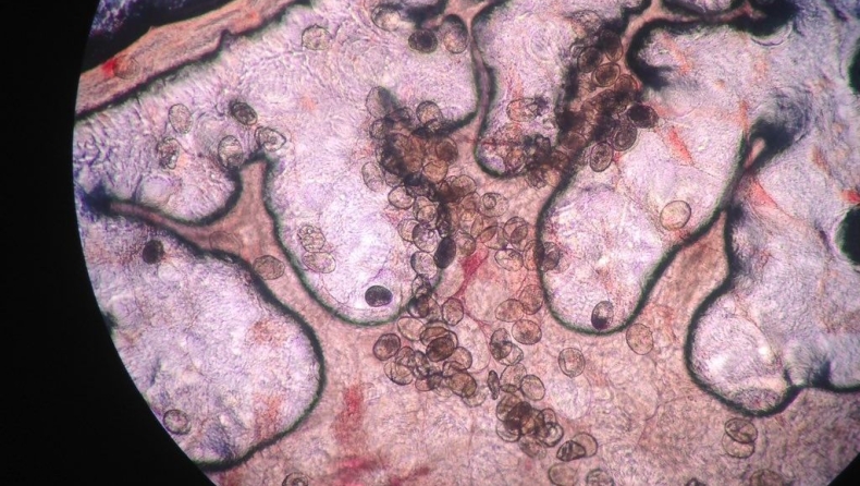 Τρόμος από παρασιτικό σκουλήκι: Προκαλεί καρκίνο και εισβάλλει στο σώμα... χωρίς να το καταλάβεις