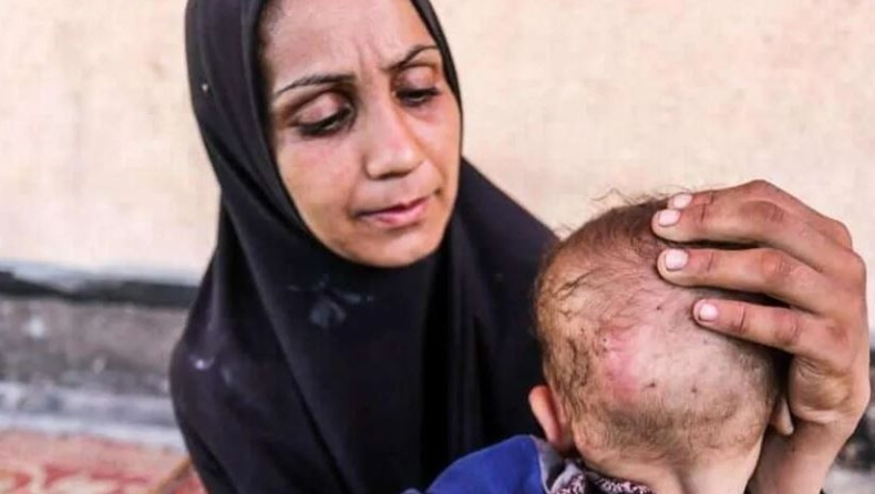 Ραγίζει καρδιές η δίχρονη Ρακίν από τη Γάζα: Παγιδευμένη από την πείνα και την αρρώστια