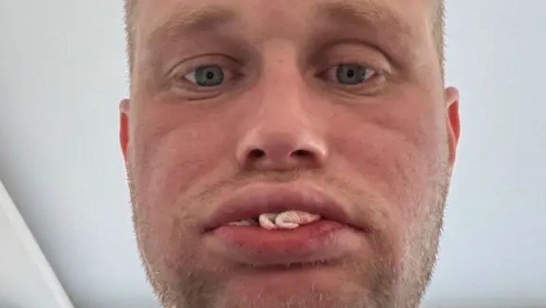 Εφιάλτης για Βρετανό: Πλήρωσε 3.500 λίρες για «νέα δόντια» στην Τουρκία και τα έχασε όλα