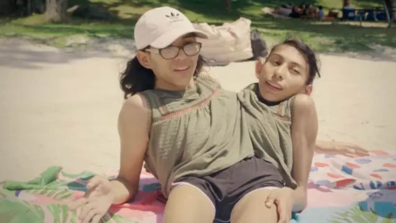 Σιαμαία δίδυμη αποκαλύπτει: Τι συμβαίνει όταν η αδερφή της είναι με τον σύζυγό της