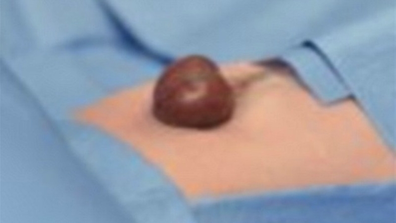 Η καρδούλα του χτυπάει έξω από το σώμα του