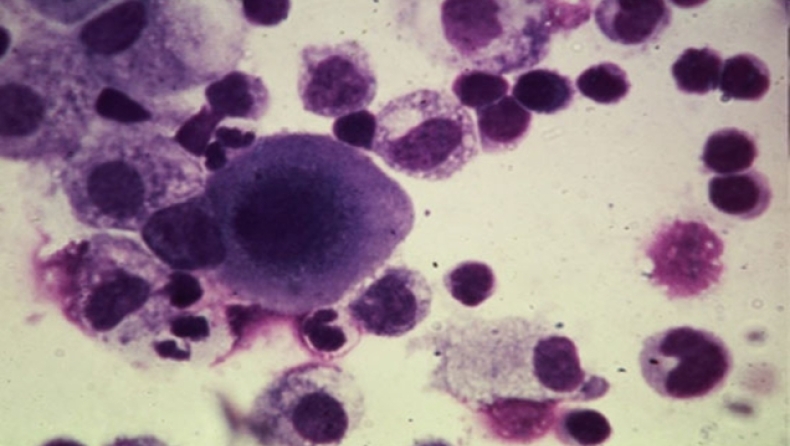 Προκαλούν... γήρανση στα καρκινικά κύτταρα!