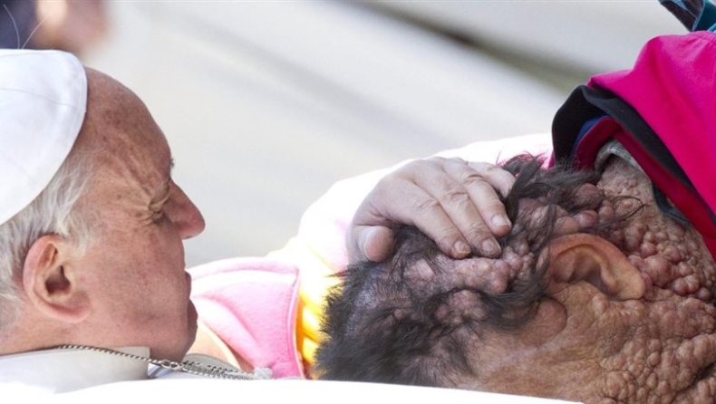 Φίλησε τις πληγές αρρώστου ο πάπας