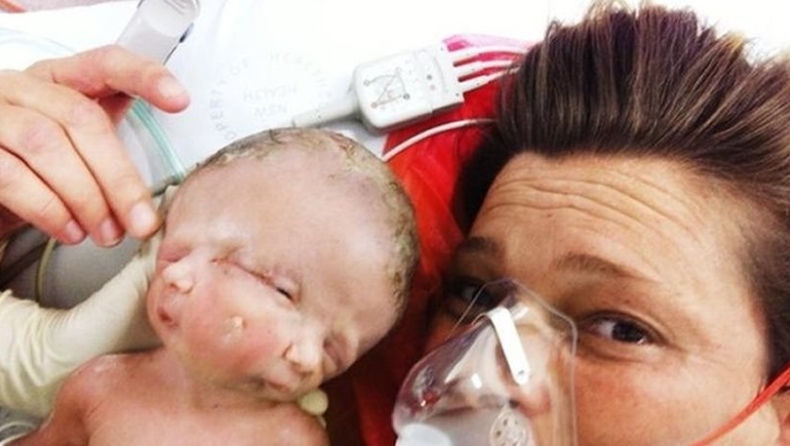 Σιαμαία δίδυμα με ένα σώμα και δύο εγκεφάλους