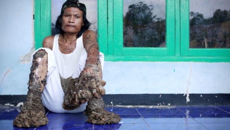 Ο άνθρωπος-δέντρο και άλλες σπάνιες παθήσεις (pics)