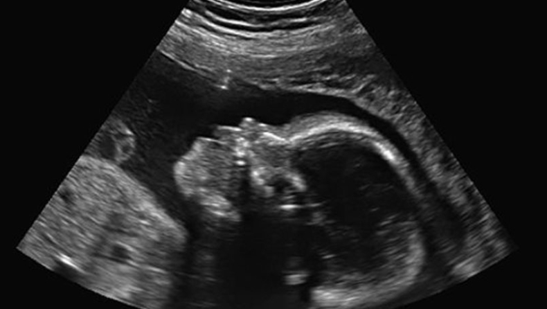 Νόμιζε πως ήταν έγκυος, αλλά είχε θανατηφόρο όγκο στην μήτρα!