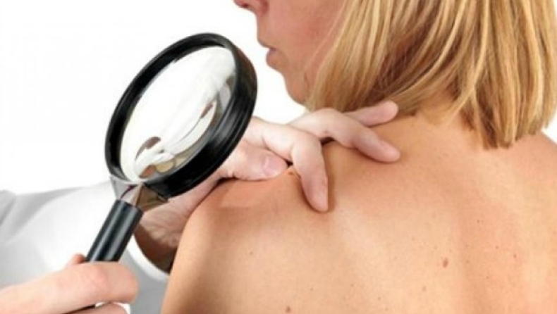 Έως το 2050 η θνησιμότητα από μελάνωμα θα μειωθεί