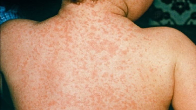 Πάνω από 300 κρούσματα ιλαράς στην χώρα μας