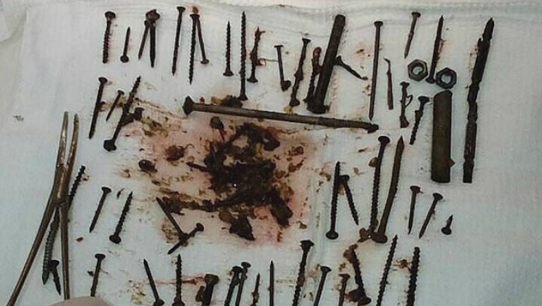 Μια γυναίκα κατάπιε καρφιά και βίδες επειδή είχε χαμηλό σίδηρο! (pics)