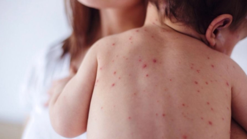 Ραγδαία αύξηση κατά 50% των κρουσμάτων ιλαράς σε ολόκληρο τον κόσμο