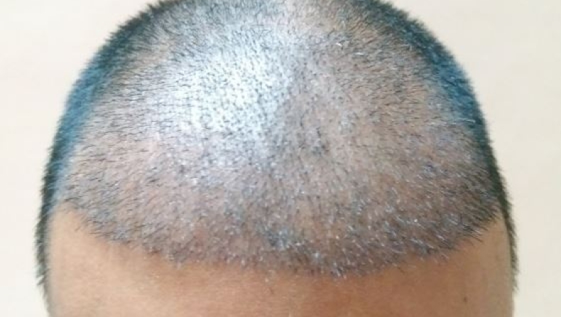 Ένας 43χρονος πέθανε μετά απο 12ωρη εμφύτευση μαλλιών (pics)