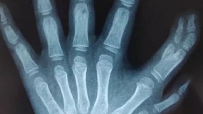 Ένα κοριτσάκι γεννήθηκε με 14 δάχτυλα στα χέρια (pics)