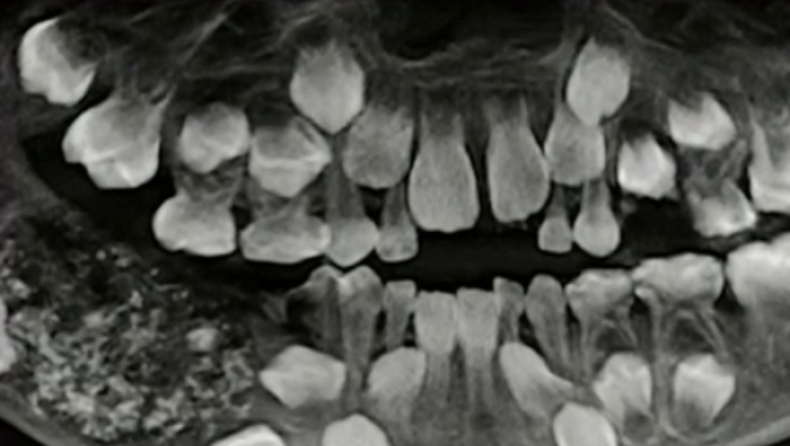 Γιατροί αφαίρεσαν από 7χρονο 526 δόντια! (vid)