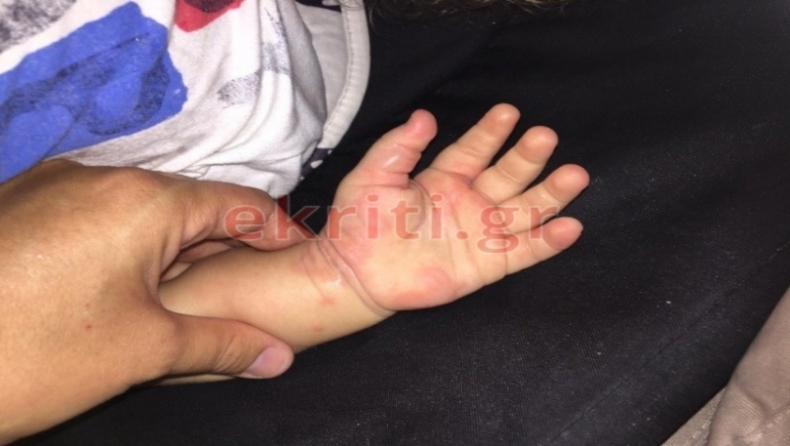 Κρήτη: Παιδί έπαθε εγκαύματα παίζοντας στην άμμο επειδή δεν είχαν σβήσει φωτιά από το προηγούμενο βράδυ (pics)