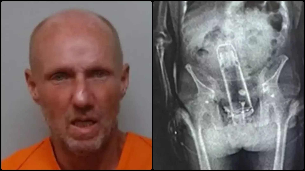 Σοκαριστική ακτινογραφία δείχνει ένα θερμός στο στομάχι Αμερικανού: Το πέρασε στη φυλακή αλλά το εντόπισαν