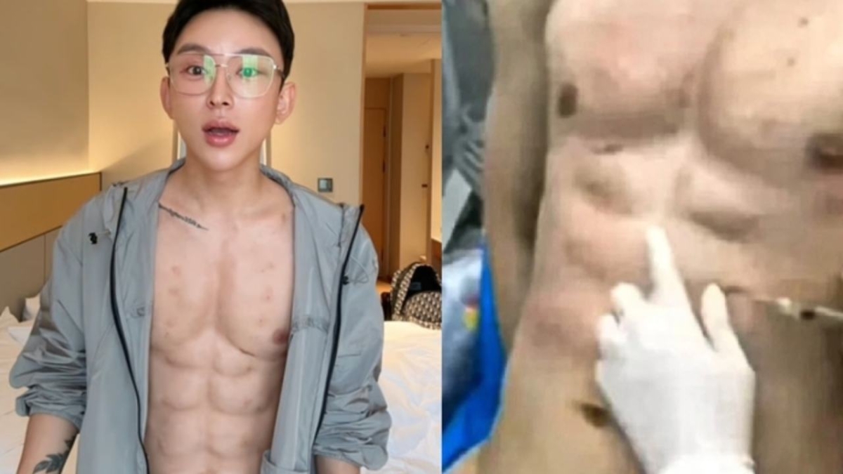 Κινέζος influencer ξόδεψε πάνω από 500.000 δολάρια για… ψεύτικους κοιλιακούς