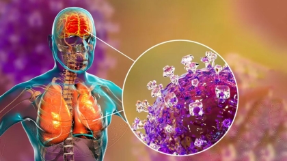 Συναγερμός για τον ιό Nipah: Πώς μεταδίδεται και ποια είναι τα συμπτώματα